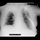 Atelectasis of right upper lobe of lung: X-ray - Plain radiograph